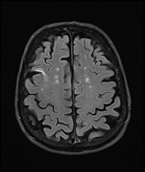 File:Acute P1 occlusion with PCA ischemia penumbra (CT perfusion) (Radiopaedia 72084-82590 Axial FLAIR 29).jpg