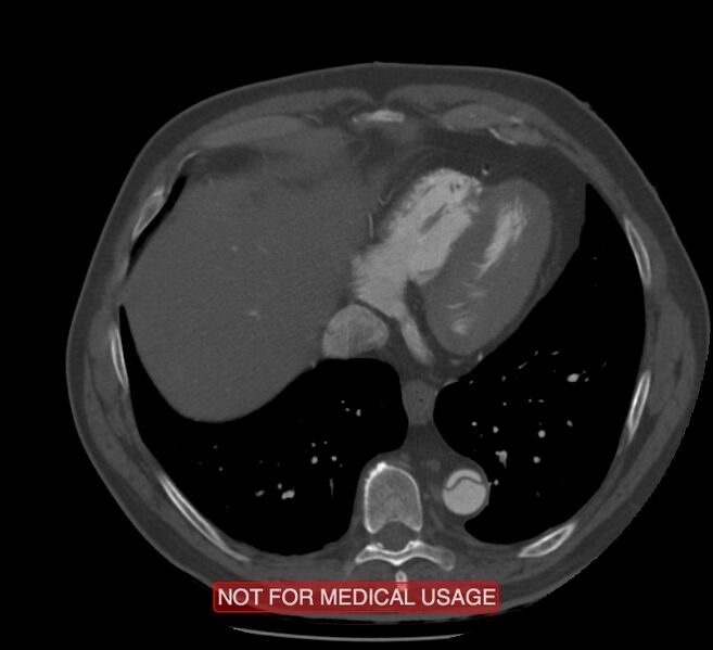 File:Acute aortic dissection - Stanford type A (Radiopaedia 40661-43285 Axial C+ arterial phase 56).jpg