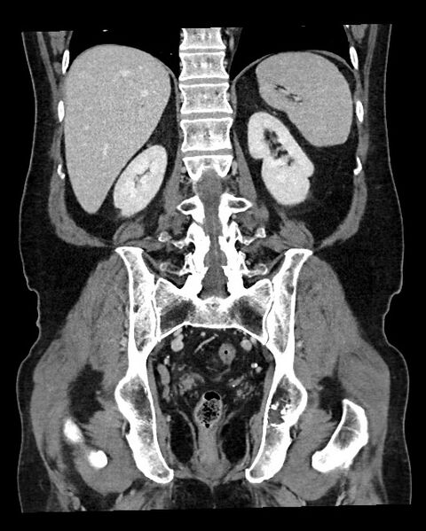 File:Acute appendicitis - large appendicoliths (Radiopaedia 61805-69820 Coronal C+ portal venous phase 95).jpg