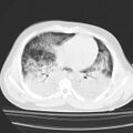 Acute aspiration pneumonitis (Radiopaedia 33605-34703 Axial lung window 61).jpg