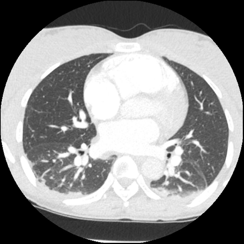 Acute chest syndrome - sickle cell disease (Radiopaedia 42375-45499 Axial lung window 105).jpg
