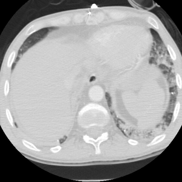 File:Acute diffuse alveolar hemorrhage (Radiopaedia 41323-44158 Axial lung window 55).jpg