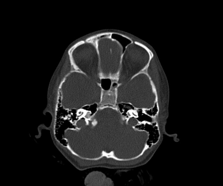 File:Acute epidural hematoma (Radiopaedia 63659-72335 Axial bone window 5).jpg