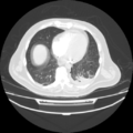 Acute heart failure (CT) (Radiopaedia 79835-93075 Axial lung window 33).png