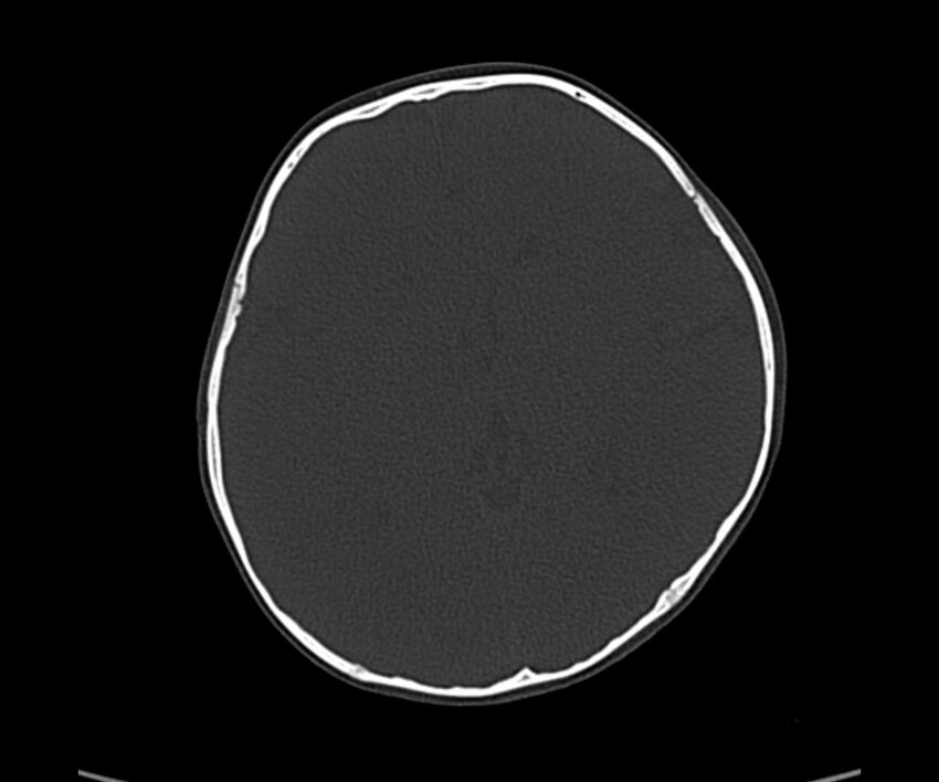 Acute hemorrhagic contusion (Radiopaedia 63660-72336 Axial bone window 35).jpg