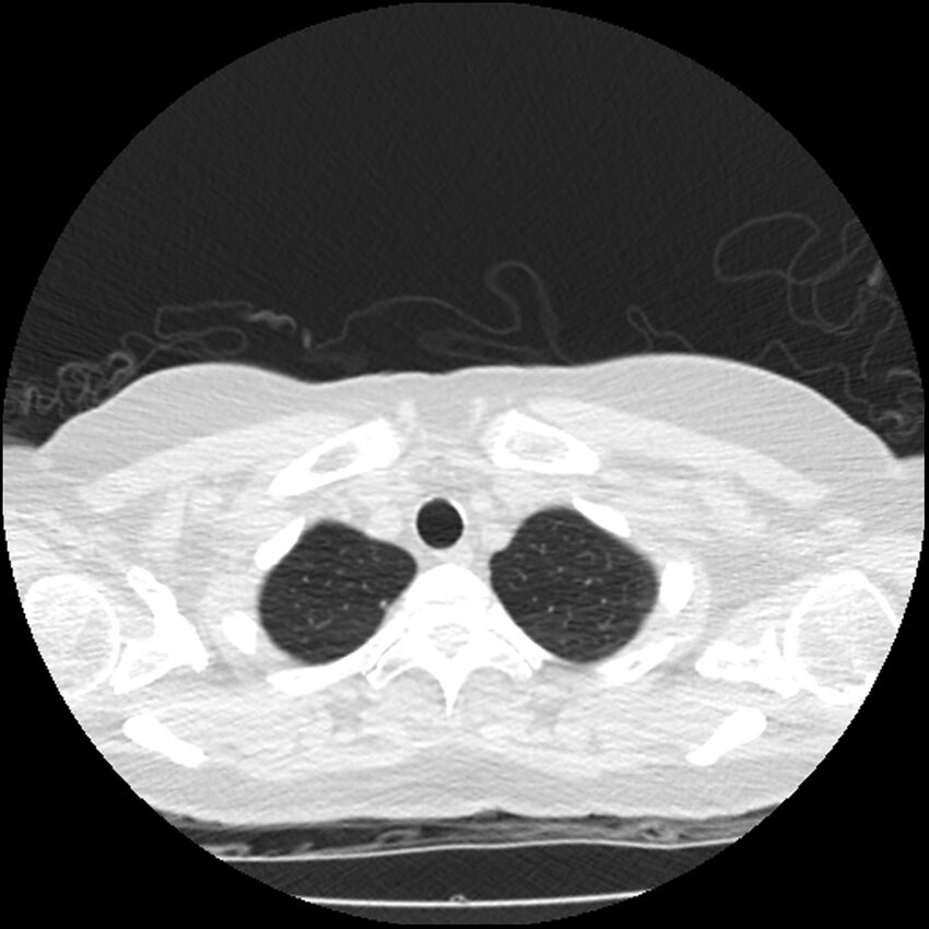 Acute interstitial pneumonitis (Radiopaedia 45404-49444 Axial lung window 10).jpg