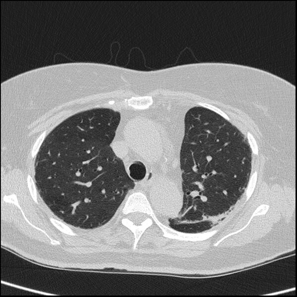 File:Acute interstitial pneumonitis (Radiopaedia 45404-49453 Axial lung window 28).jpg