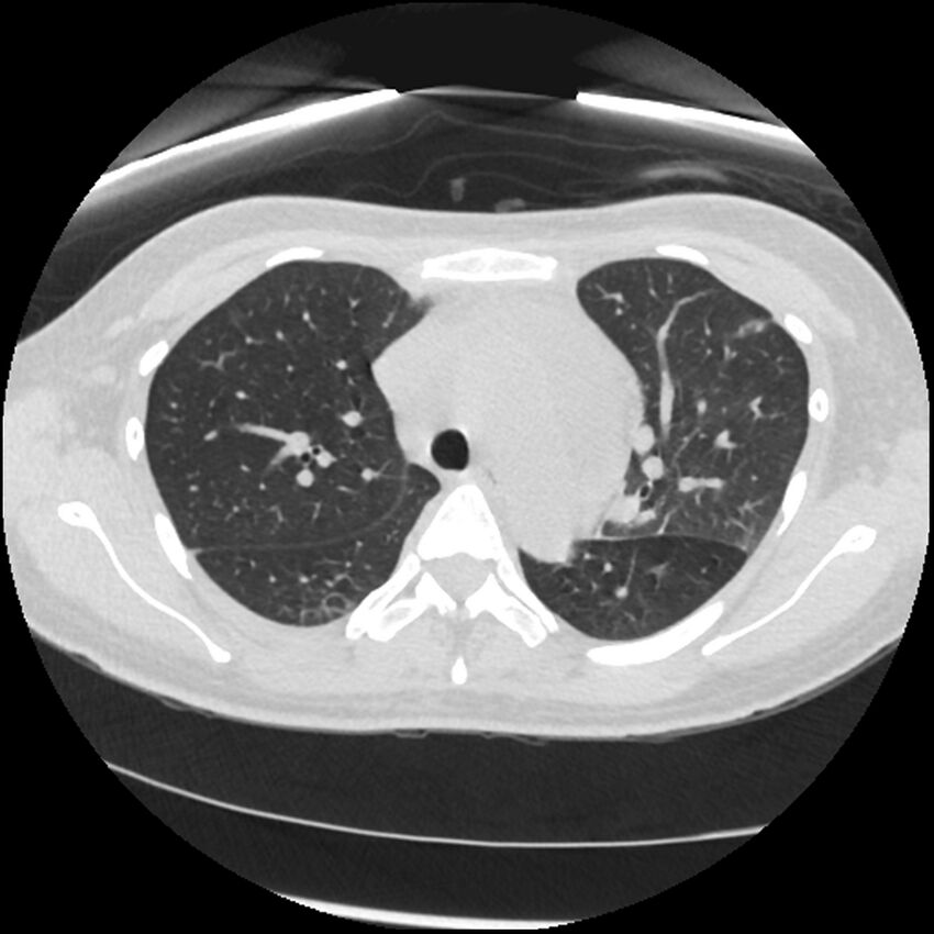 Acute lupus nephritis (Radiopaedia 45832-50107 Axial lung window 29).jpg