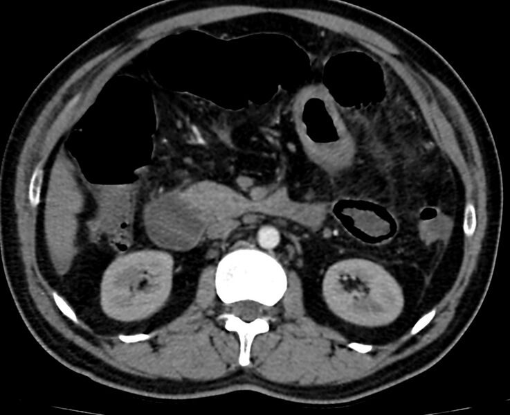 File:Acute mesenteric ischemia - superior mesenteric artery thrombosis (Radiopaedia 73947-84776 Axial C+ arterial phase 43).jpg