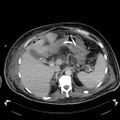 Acute pancreatic necrosis (Radiopaedia 13560-18503 Axial C+ portal venous phase 19).jpg