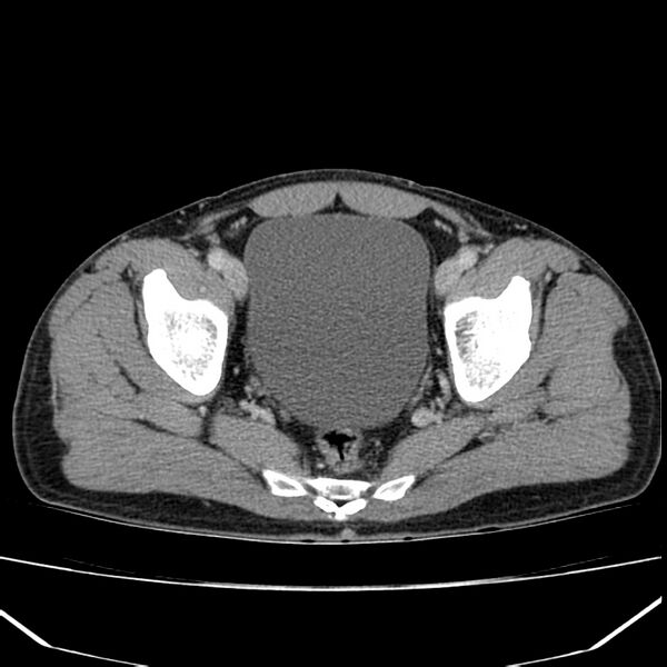 File:Acute pancreatitis (Radiopaedia 22572-22596 Axial C+ portal venous phase 64).jpg