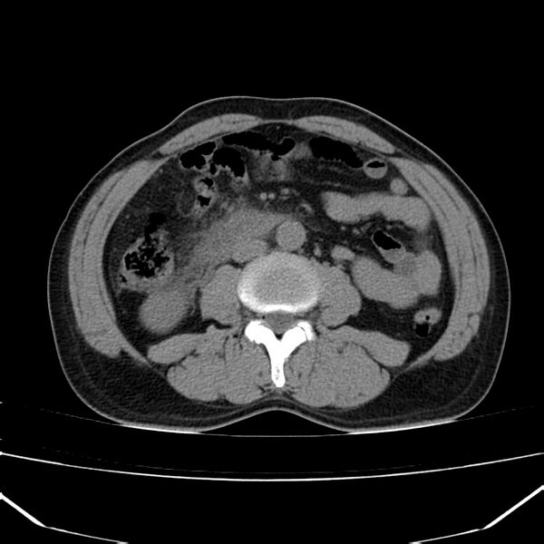 File:Acute pancreatitis (Radiopaedia 22572-22596 Axial non-contrast 34).jpg