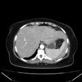 Acute pancreatitis - Balthazar C (Radiopaedia 26569-26714 Axial C+ arterial phase 14).jpg