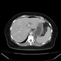 Acute pancreatitis - Balthazar C (Radiopaedia 26569-26714 Axial C+ portal venous phase 27).jpg