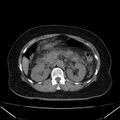 Acute pancreatitis - Balthazar C (Radiopaedia 26569-26714 Axial non-contrast 37).jpg