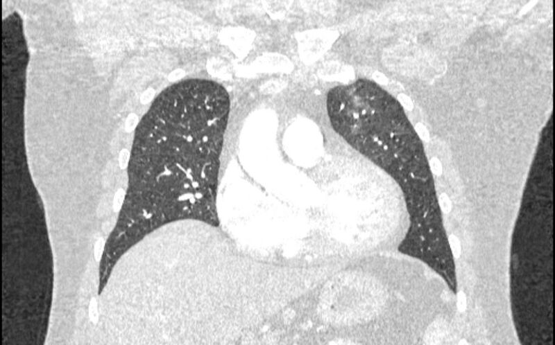 File:Acute pulmonary embolism with pulmonary infarcts (Radiopaedia 77688-89908 Coronal lung window 24).jpg