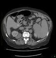 Acute renal failure post IV contrast injection- CT findings (Radiopaedia 47815-52559 Axial C+ portal venous phase 30).jpg