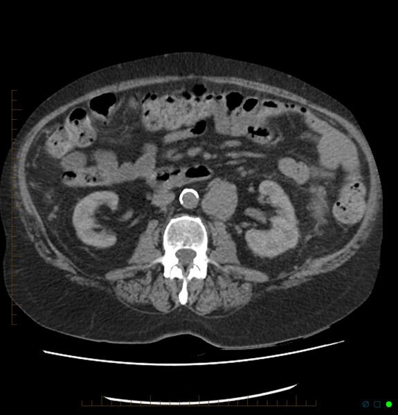 File:Acute renal failure post IV contrast injection- CT findings (Radiopaedia 47815-52559 Axial C+ portal venous phase 38).jpg