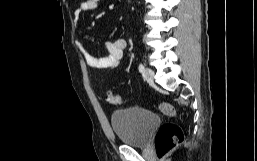 Acute sigmoid colon diverticulitis (Radiopaedia 55507-61976 Sagittal C+ portal venous phase 21).jpg