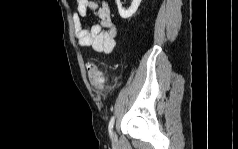 File:Acute sigmoid colon diverticulitis (Radiopaedia 55507-61976 Sagittal C+ portal venous phase 85).jpg