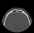 Acute sinusitis (Radiopaedia 23161-23215 Axial bone window 75).jpg