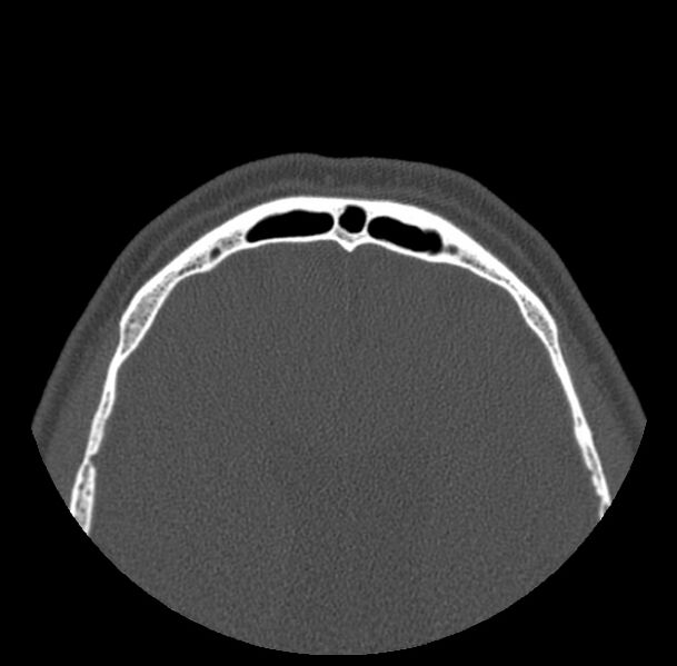 File:Acute sinusitis (Radiopaedia 23161-23215 Axial bone window 75).jpg