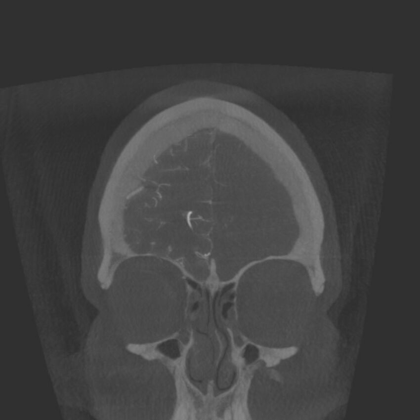 Acute subarachnoid hemorrhage and accessory anterior cerebral artery (Radiopaedia 69231-79010 Coronal arterial - MIP 13).jpg