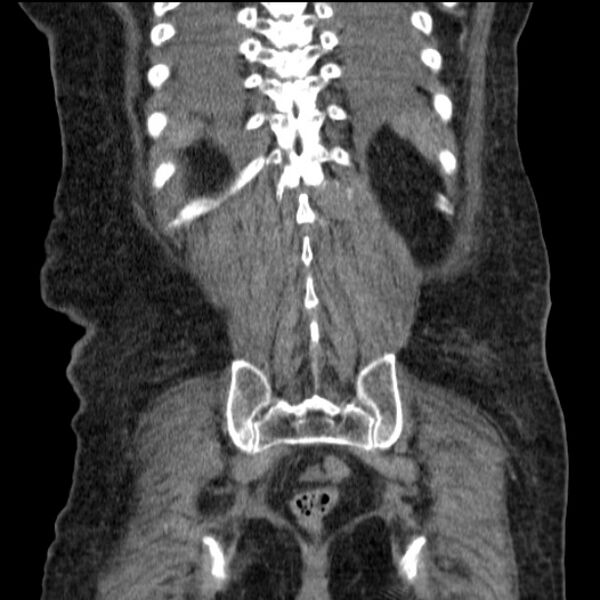 File:Acute tubular necrosis (Radiopaedia 28077-28334 D 69).jpg