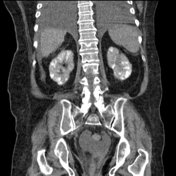 File:Acute tubular necrosis (Radiopaedia 28077-28334 G 61).jpg
