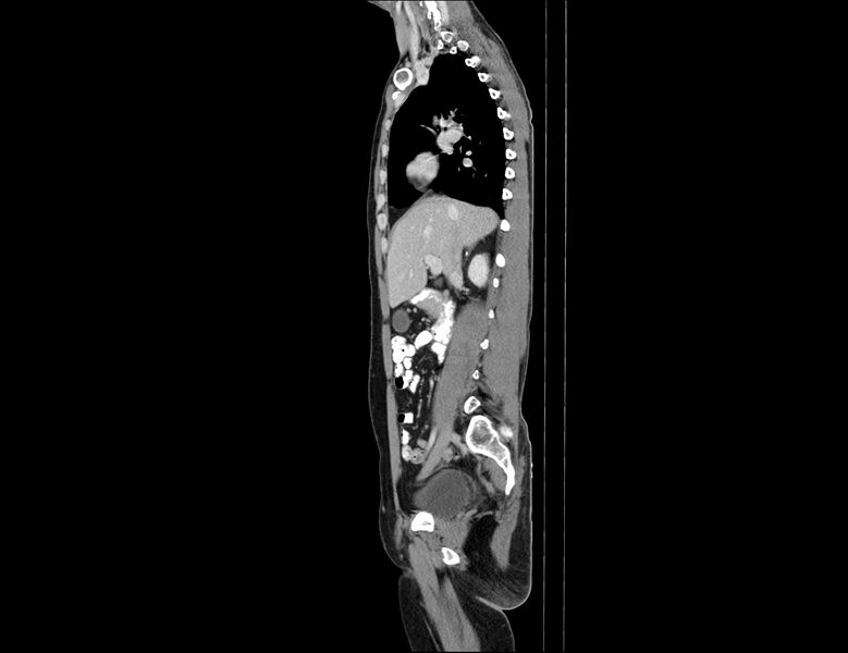 File:Addison disease (Radiopaedia 49318-54412 Sagittal C+ portal venous phase 43).jpg