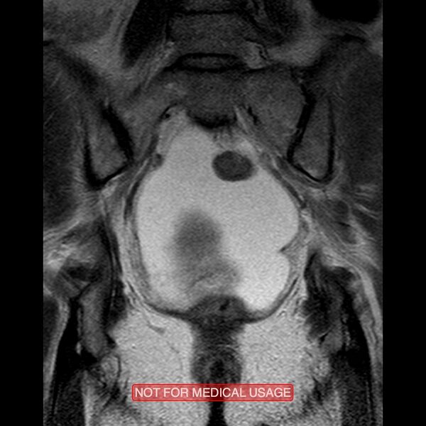 File:Adenocarcinoma of the cervix (Radiopaedia 28373-28615 Coronal T2 15).jpg