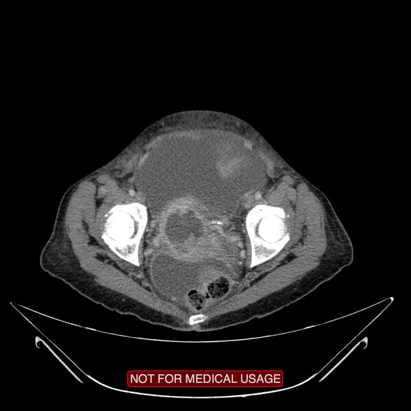 File:Adenocarcinoma of the cervix (Radiopaedia 28373-28616 Axial C+ portal venous phase 21).jpg