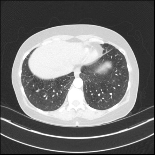 File:Adenocarcinoma of the lung (Radiopaedia 44205-47803 Axial lung window 73).jpg