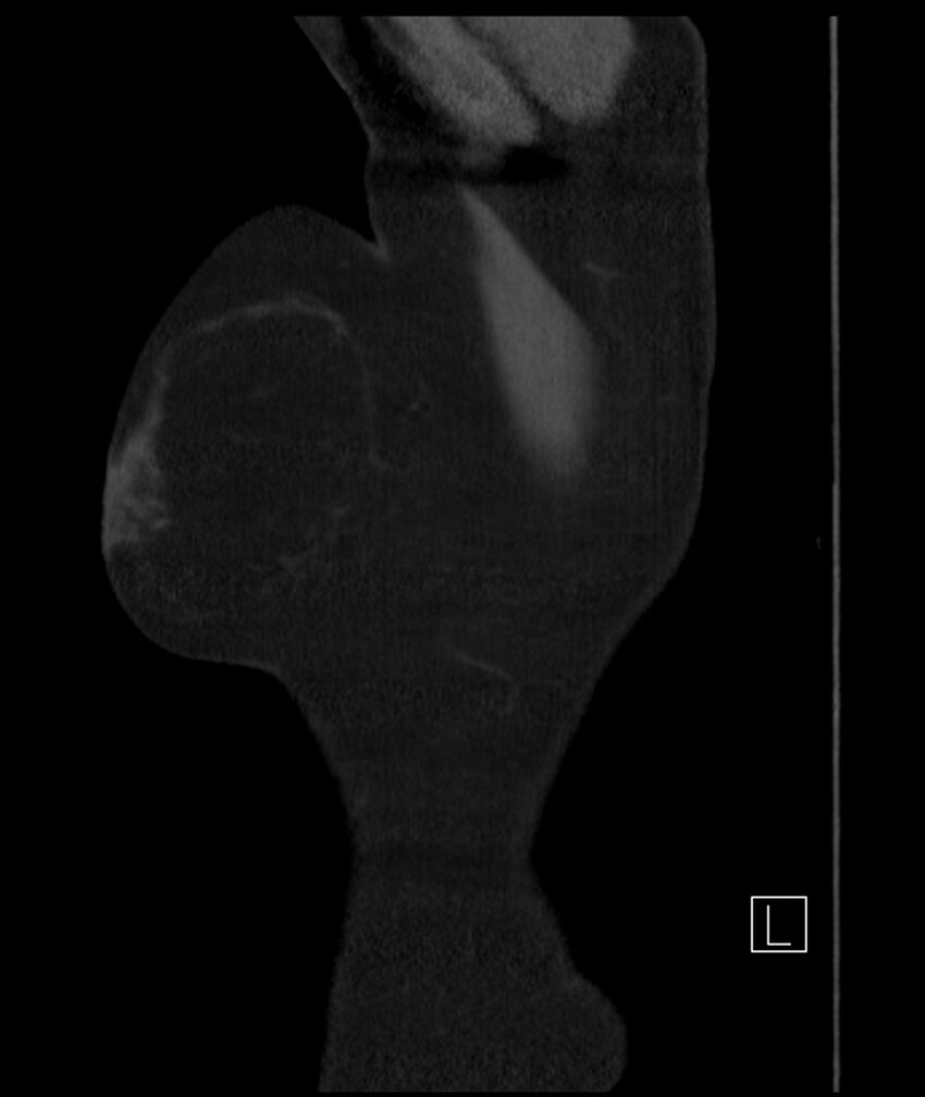Adenocarcinoma of the lung (Radiopaedia 44205-47803 Sagittal C+ portal venous phase 58).jpg