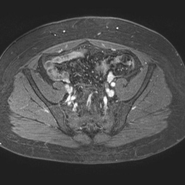File:Adenomyoma of the uterus (Radiopaedia 9871-10439 Axial T1 C+ fat sat 20).jpg