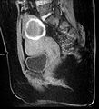 Adenomyosis with endometrioma (Radiopaedia 6753-7952 Sagittal T1 fat sat 1).jpg