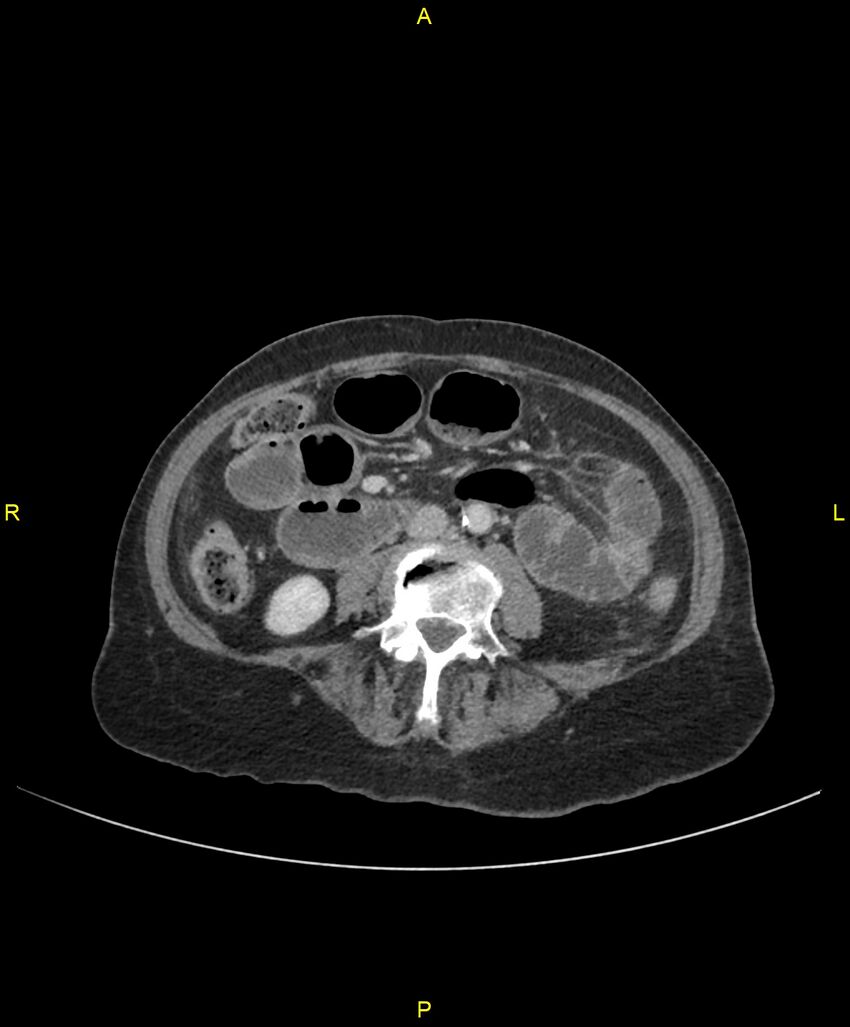 Adhesional small bowel obstruction (Radiopaedia 85402-101024 Axial C+ portal venous phase 155).jpg