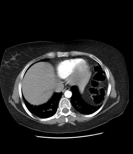 File:Adrenal cortical carcinoma with IVC invasion and thrombosis (Radiopaedia 34307-35597 Axial C+ arterial phase 8).jpg