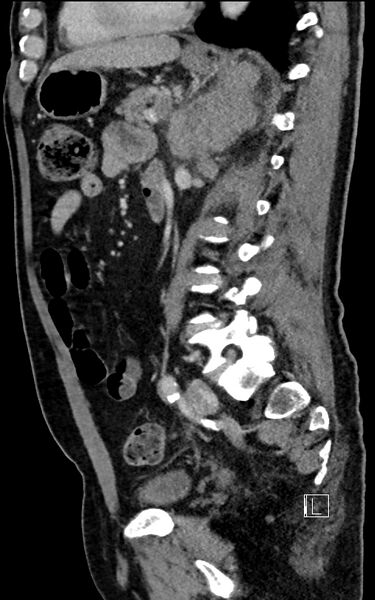 File:Adrenal lymphoma (Radiopaedia 73730-84529 Sagittal C+ portal venous phase 68).jpg