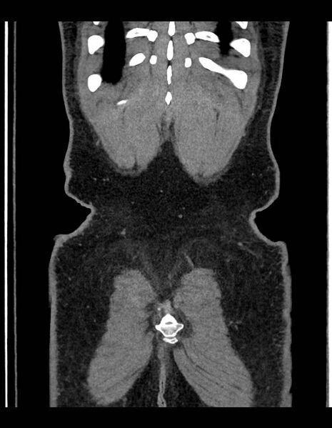 File:Adrenal myelolipoma - bilateral (Radiopaedia 74805-85810 Coronal C+ portal venous phase 52).jpg