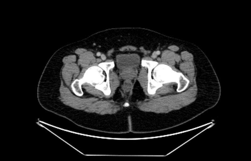 File:Adrenocortical carcinoma (Radiopaedia 80134-93438 Axial C+ portal venous phase 129).jpg