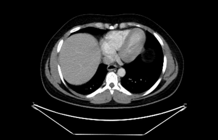 Adrenocortical carcinoma (Radiopaedia 80134-93438 Axial C+ portal venous phase 14).jpg