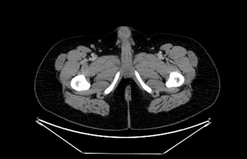 Adrenocortical carcinoma (Radiopaedia 80134-93438 Axial C+ portal venous phase 144).jpg
