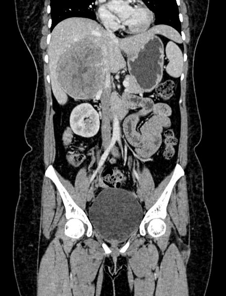 File:Adrenocortical carcinoma (Radiopaedia 87281-103569 Coronal C+ portal venous phase 36).jpg