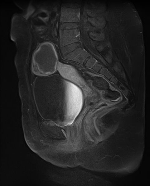 File:Adult granulosa cell tumor of the ovary (Radiopaedia 71581-81950 Sagittal T1 C+ fat sat 12).jpg