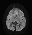 Aicardi syndrome (Radiopaedia 66029-75205 Axial DWI 12).jpg
