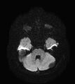 Aicardi syndrome (Radiopaedia 66029-75205 Axial DWI 6).jpg