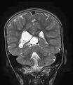 Aicardi syndrome (Radiopaedia 66029-75205 Coronal T2 17).jpg