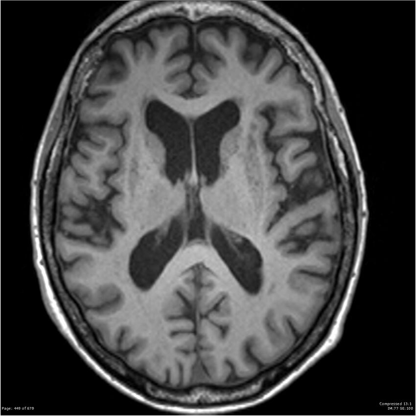 Alzheimer disease (Radiopaedia 22196-22226 Axial T1 37).jpg