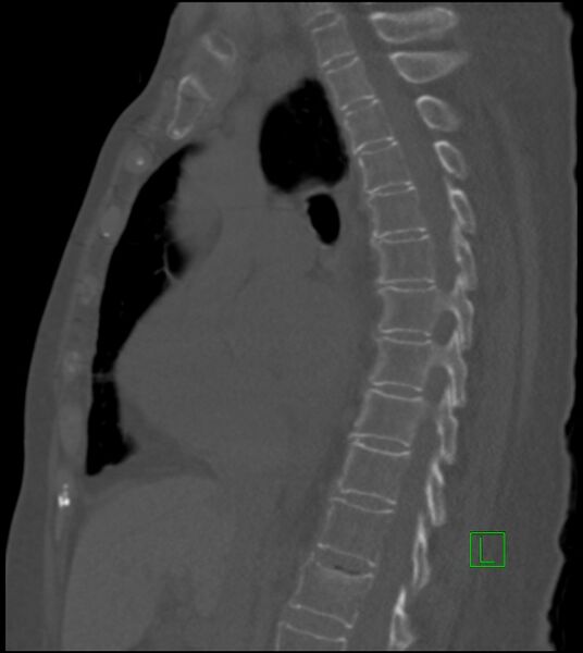 File:Amiodarone deposition in the liver (Radiopaedia 77587-89780 Sagittal bone window 53).jpg